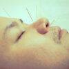 Benefits of Acupuncture