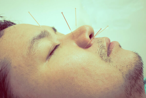 Benefits of Acupuncture