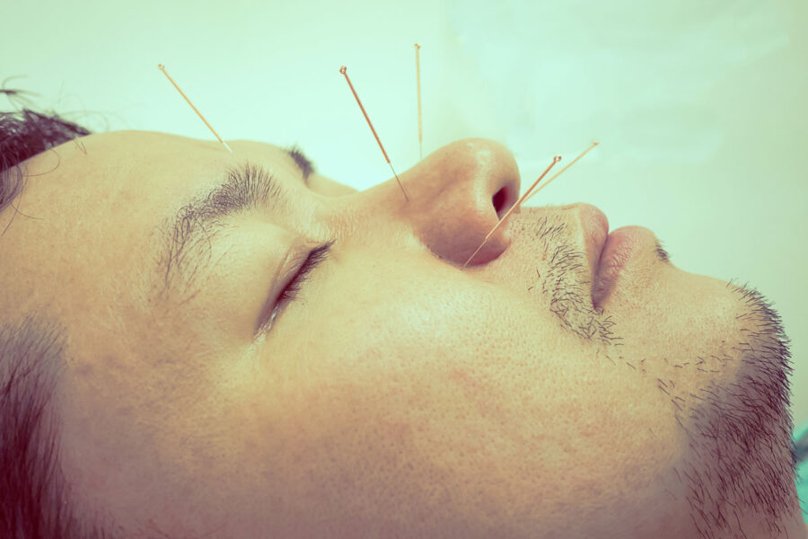 Benefits of Acupuncture